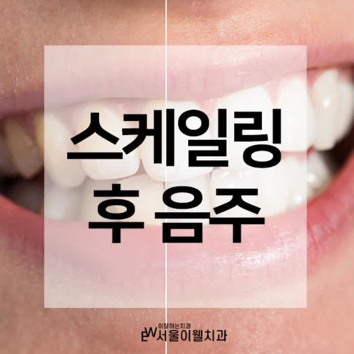 스케일링 후 음주 얼마나 참아야될까요?