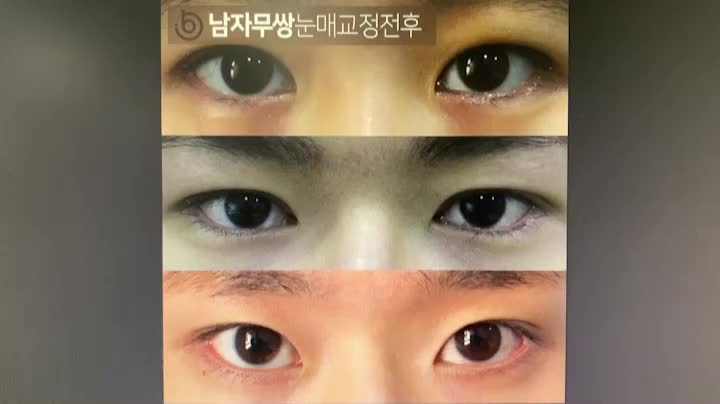 궁금한 남자무쌍눈매교정전후 : 네이버 블로그