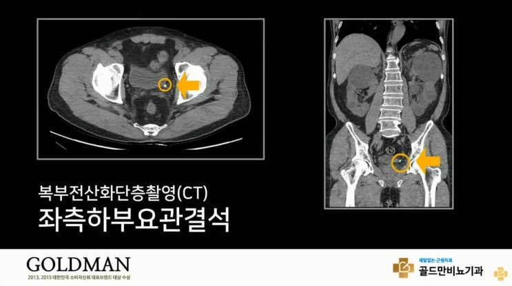 요관내시경수술 체외충격파쇄석술과 요관내시경수술 : 네이버 블로그