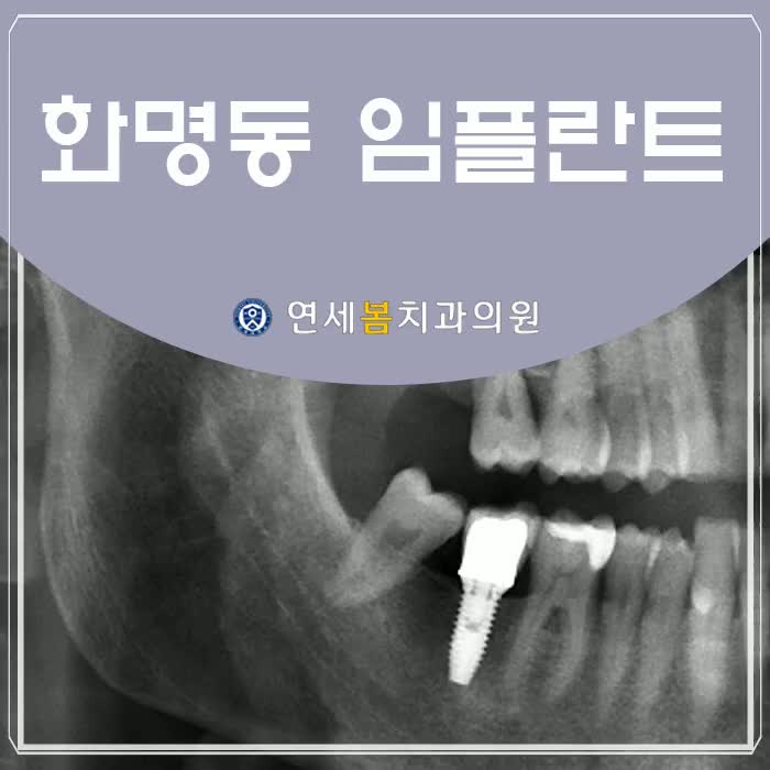  화명동임플란트 장점과 임플란트 식립이 중요한 이유!