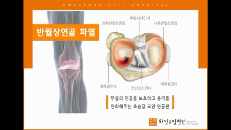 화성유일병원과 함께 하는 '반월상연골파열과 연골이식수술' : 네이버 블로그