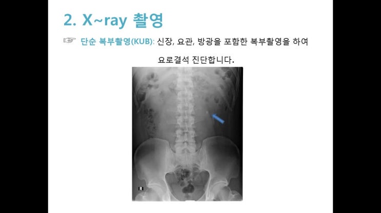  [지영환화인의원] 24시간 요로결석, 체외충격파 쇄석술 안내문