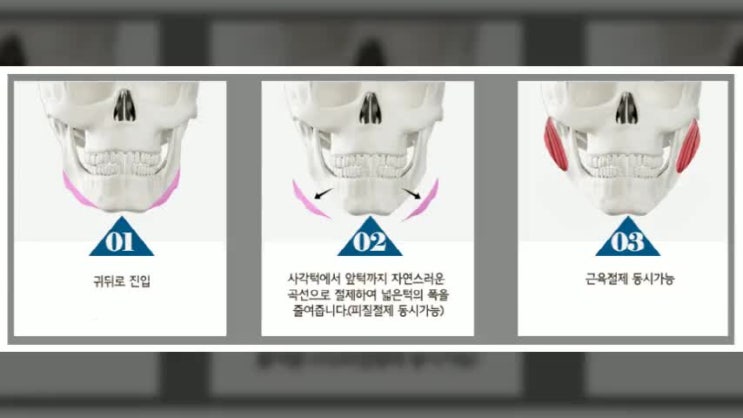  전신마취 없이 귀뒤로 v라인사각턱 가능하다!
