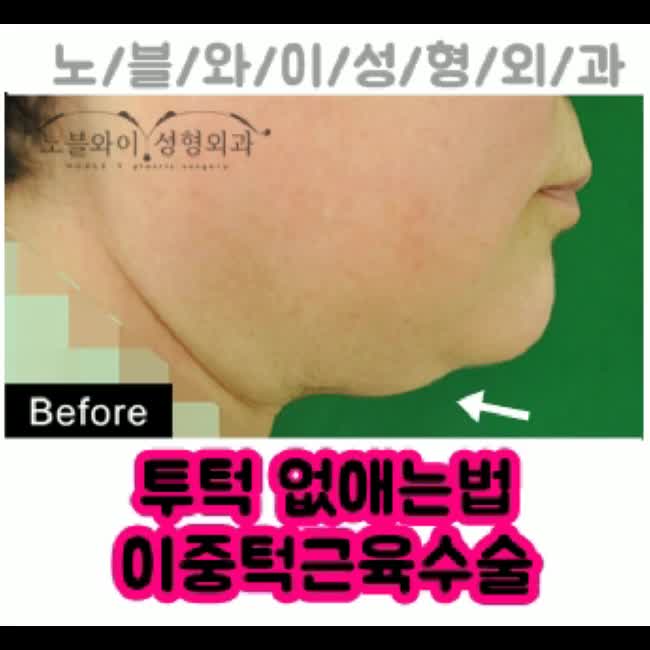  투턱 없애는법 얼굴이 커보여요