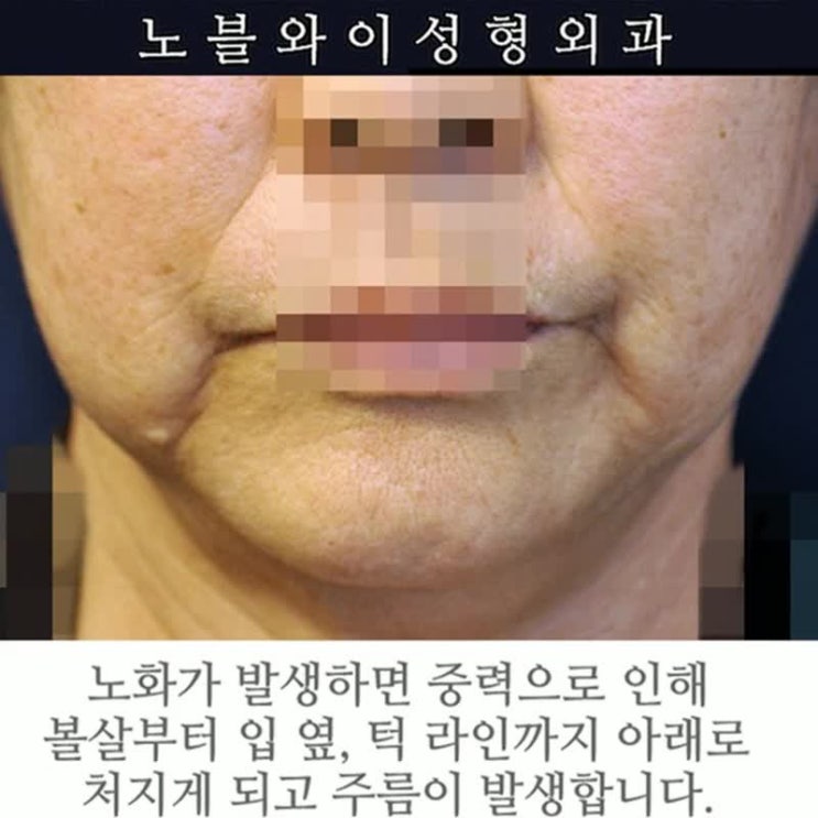  안면리프팅수술 십년넘게가요?