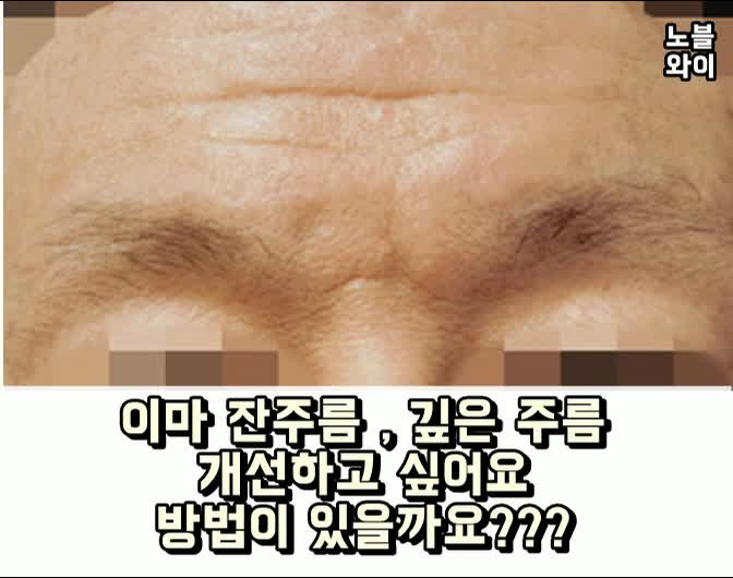  이마주름제거수술비용 이렇게 효과를 볼수 있다니!