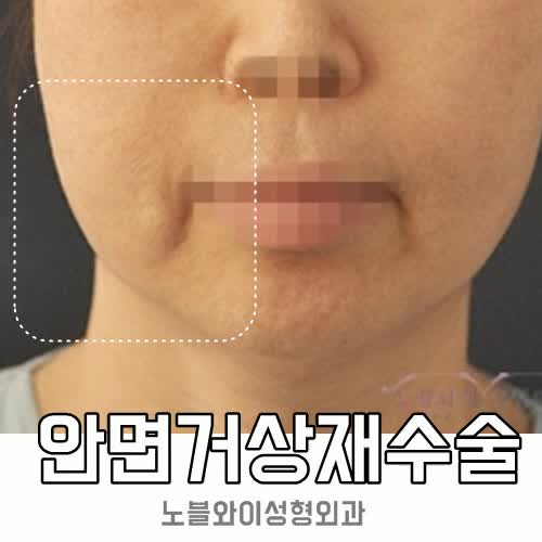  안면거상재수술 이번엔 효과 볼 수 있을까?