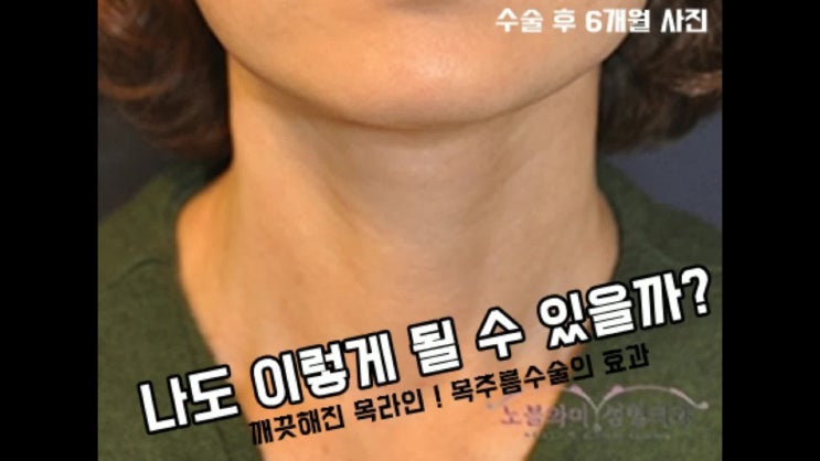  목주름수술 이게 말이 돼?