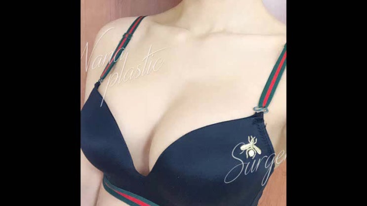  가슴성형잘하는곳 신중하게 선택하려면