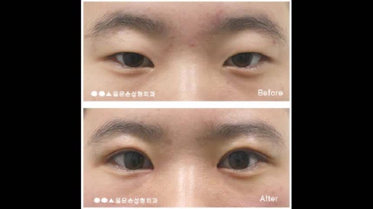  짝눈재수술 완성도 높은 교정을 위한 방법