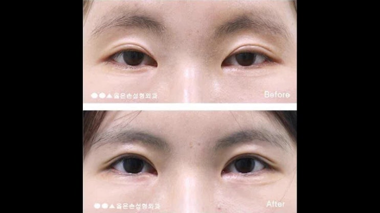  쌍꺼풀재수술잘하는병원 이것이 중요