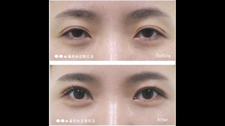  눈매교정잘하는병원 정확한 원인 분석