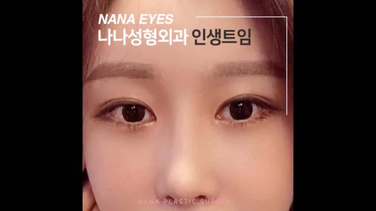  연예인뒷트임 커다람의 비밀은
