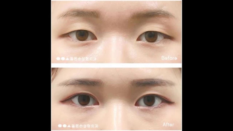  안검하수눈매교정 초기진단의 중요성