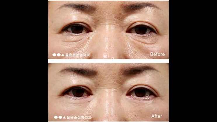  하안검수술회복기간 평균적인 회복기간