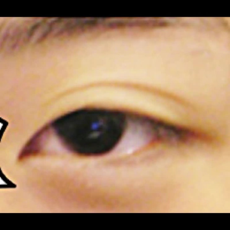  쌍꺼풀겹주름 재수술로 깔끔해진 경우