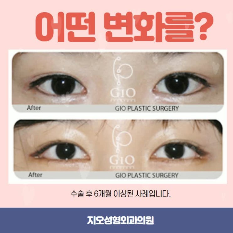  앞트임윗트임 같은 수술인지 다른 수술인지