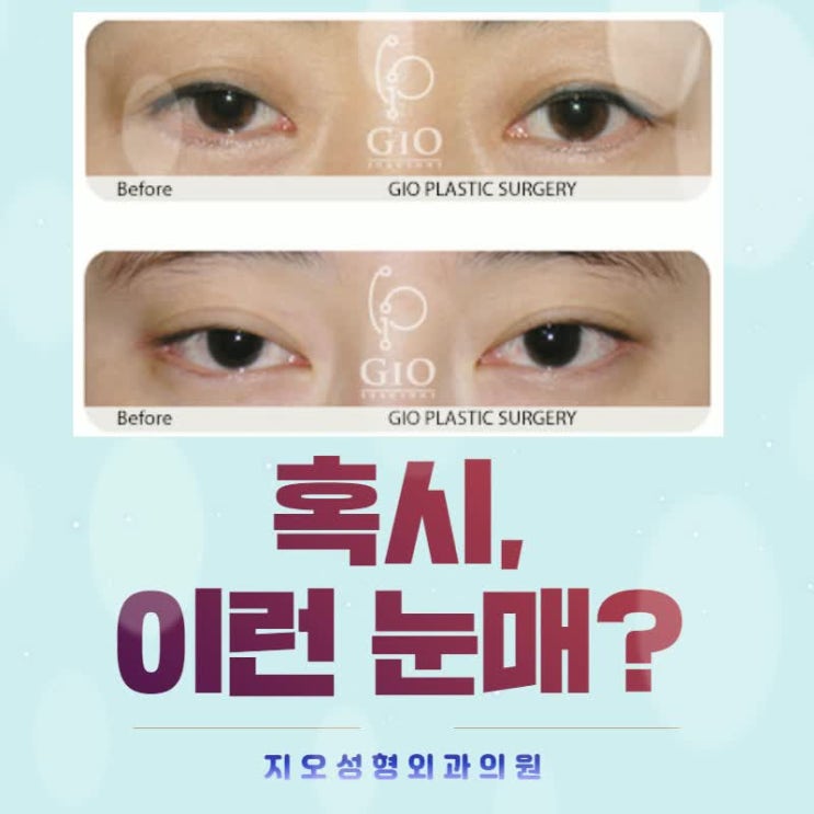  짝눈쌍수 이것만 받으면 비대칭 교정 가능할까