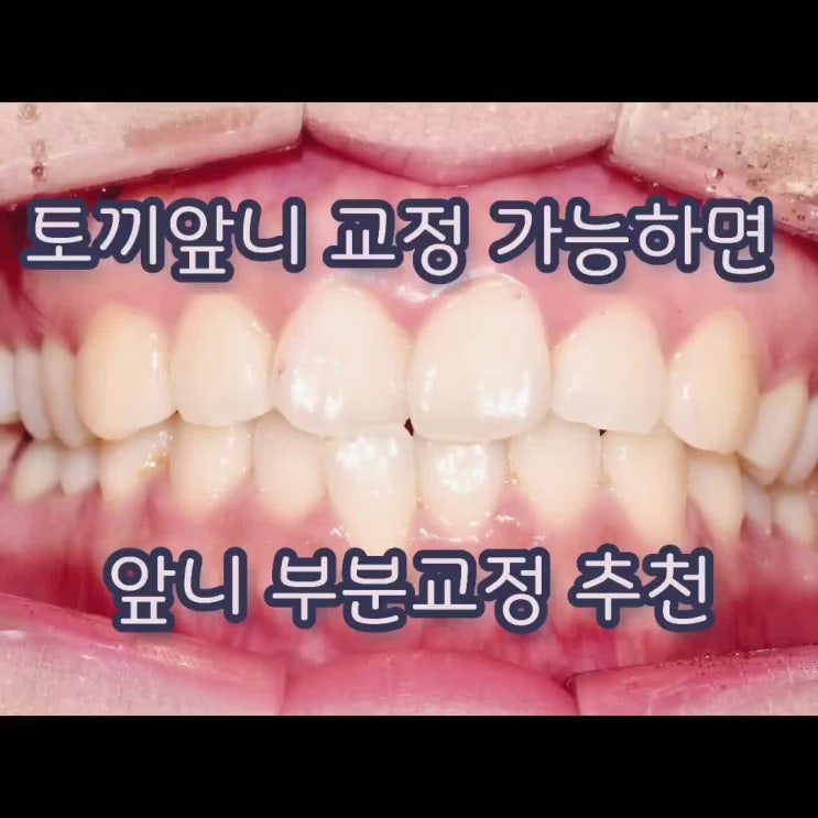  토끼이빨 교정 가능하면 토끼앞니 부분 교정 추천