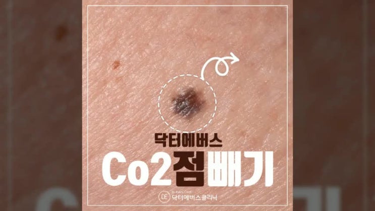  구월동점빼는곳에서 Co2점빼기로 깨끗하게 쏙쏙!