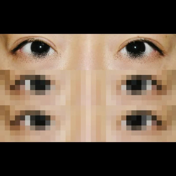  쌍수 라인 낮추기 해야하는 상태라면
