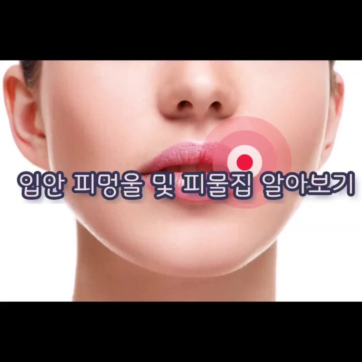  입안 피멍울 및 피물집 알아보기