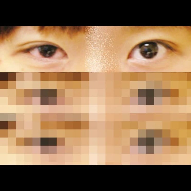  쌍수 라인 짝짝이 비대칭 해결하려면