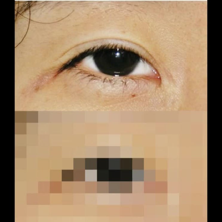  눈비율 중요성 쌍수전 꼭 확인사항