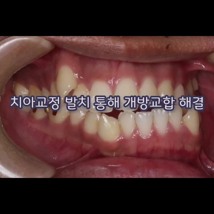  발치 이용해 개방교합 고치기