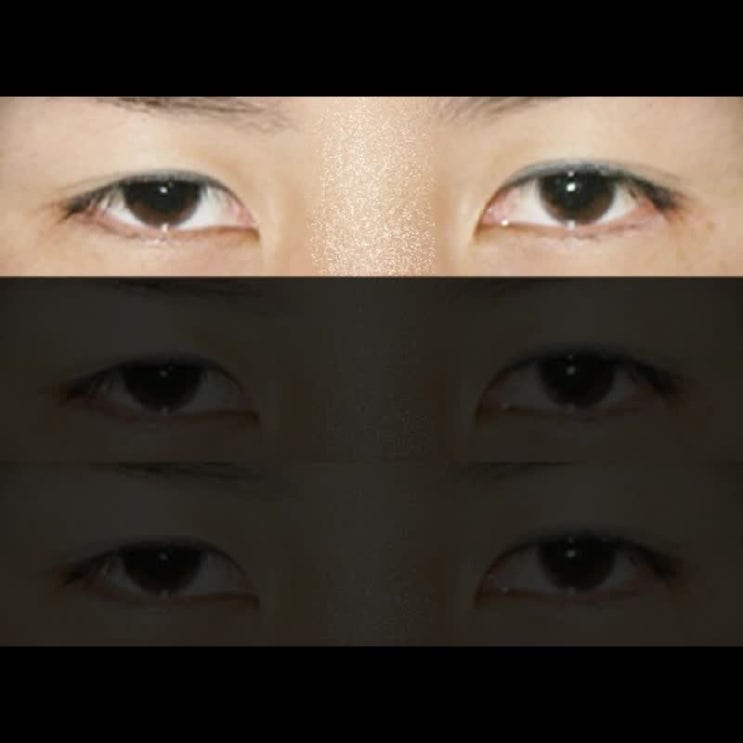  [칼럼] 눈매교정 후 짝눈교정 시 주의사항