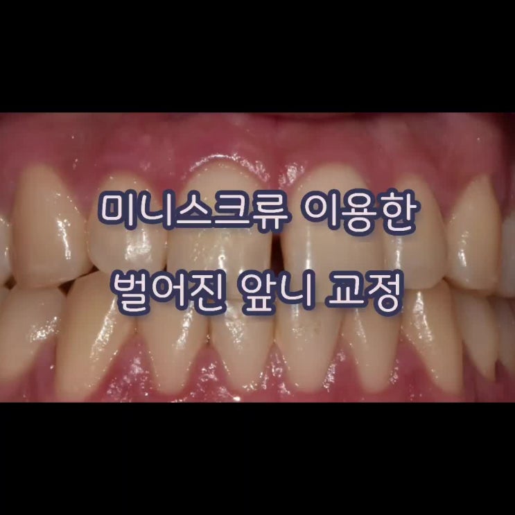  미니스크류 이용하여 벌어진 앞니 해결하기