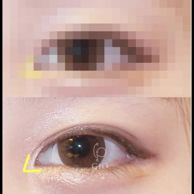  앞트임복원흉터 얼마나 남을까