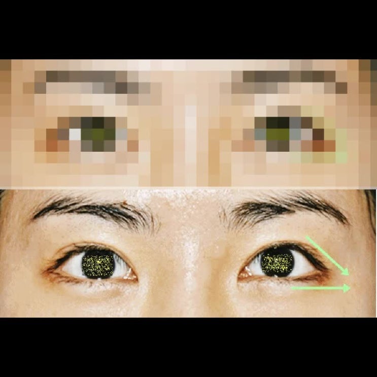  뒤트임 실밥 붓기 회복기간 체크하기