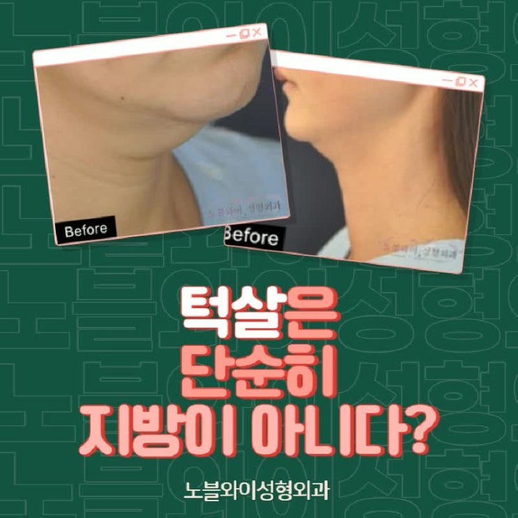  턱살제거수술 지방흡입보다 좋을까