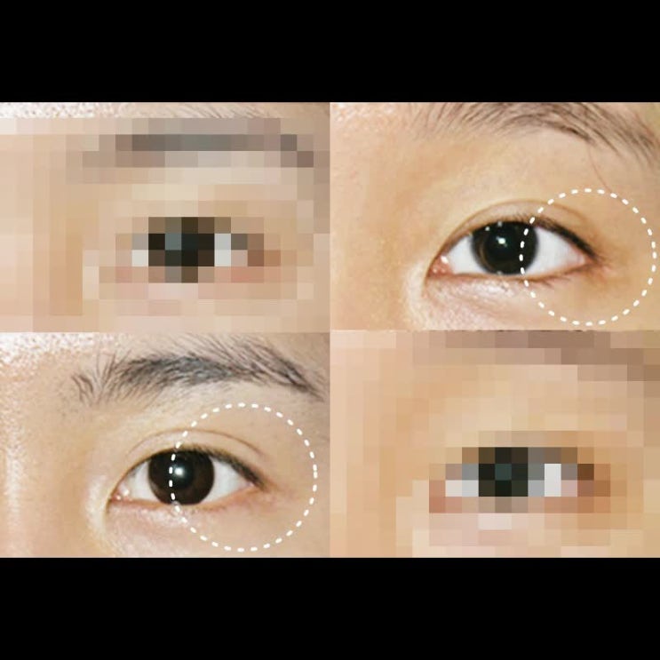  비절개 뒤트임 절개 뒤트임 다른점