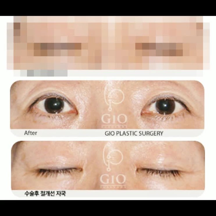  중년눈성형 상안검수술가격 사례 체크