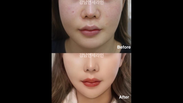  녹는실리프팅 맞춤형실 선택방법