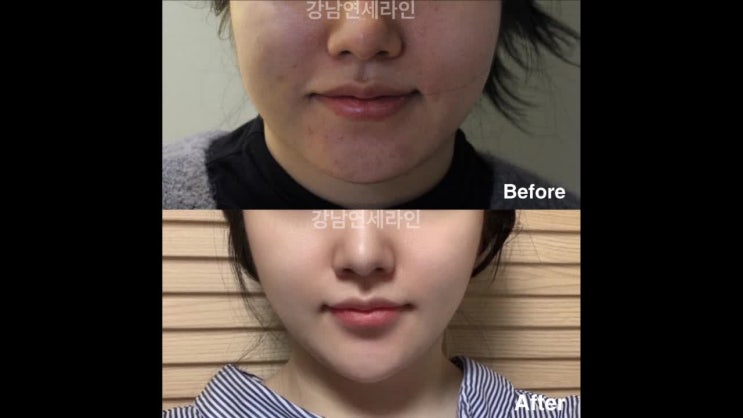  울트라v리프팅 시술 방법과 후기