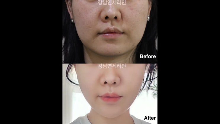  이중턱실리프팅 고급스러운 턱라인