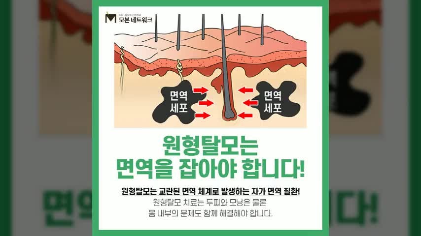 인천원형탈모병원 어디에 초점 맞출까