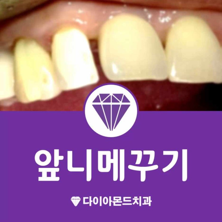  서산앞니메우기 앞니 레진으로 티나지 않게 치료했어요!