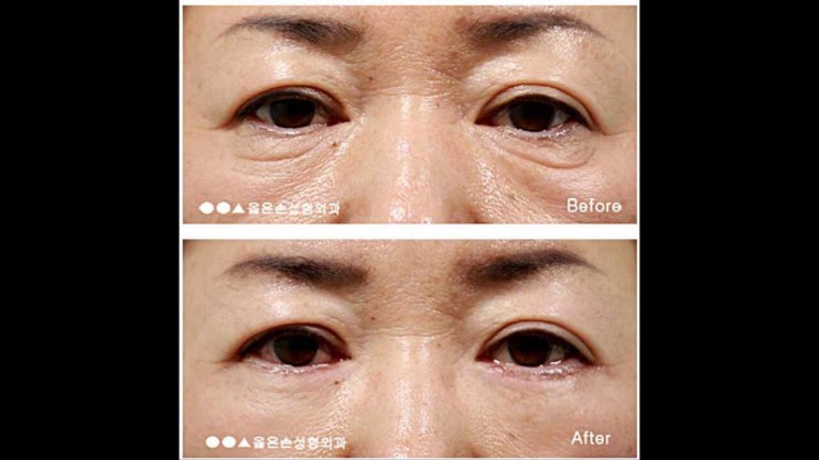  옳은손성형외과 5월 수술후기 업데이트