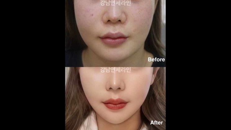 실리프팅후붓기 실의종류에 따른 기간