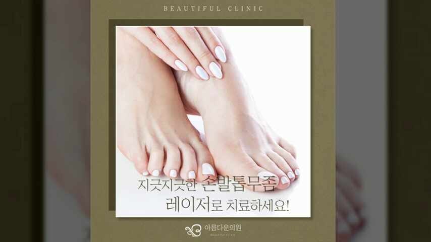 부산무좀치료 상태에 따라