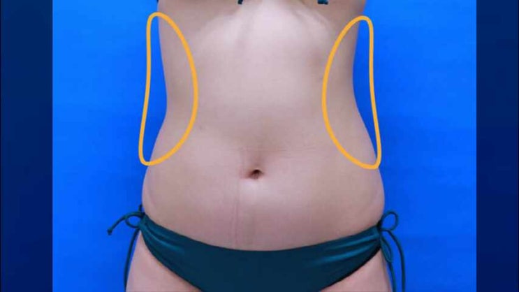  출산후몸매관리 복부슈링크 제왕절개후뱃살리프팅 배 탄력 시술 추천