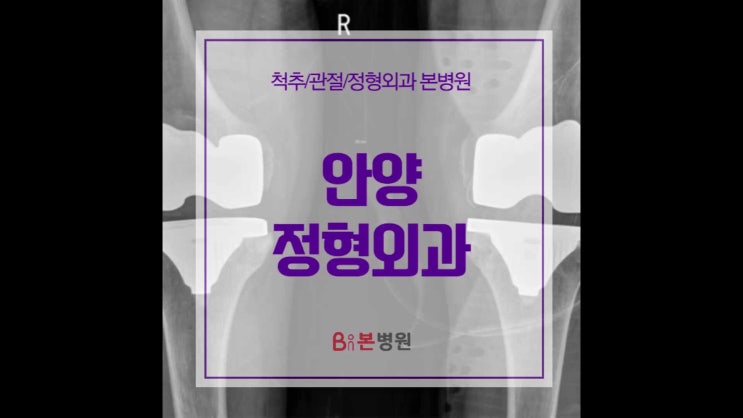  안양정형외과 무릎인공관절 고려할 때 중요한 것은