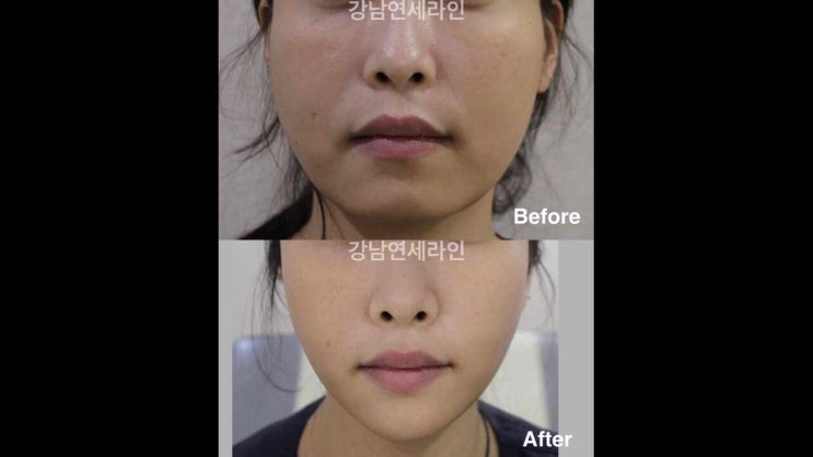  안면거상술후관리 깔끔한 결과