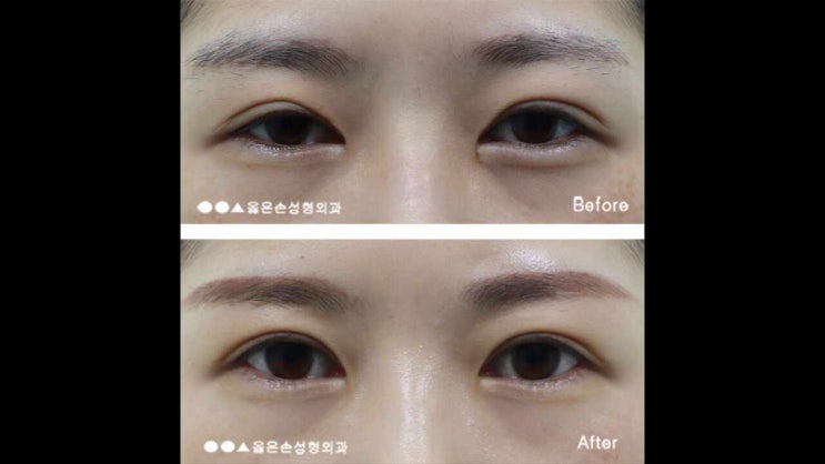 눈재수술잘하는곳 안정성을 높이는 법