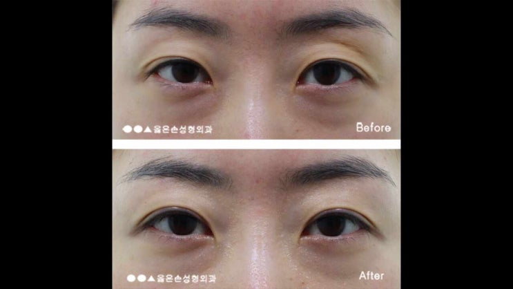  짝눈눈매교정 해결방법 총정리