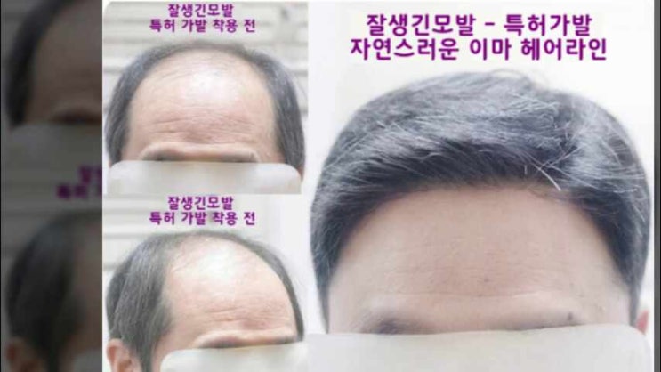  엠자가발 민머리까지 커버를